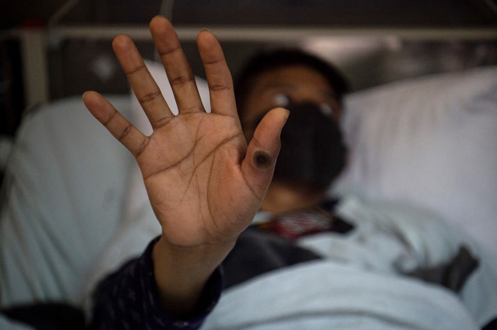 Saúde confirma primeiro caso de nova cepa de mpox no Brasil – Saúde – CartaCapital