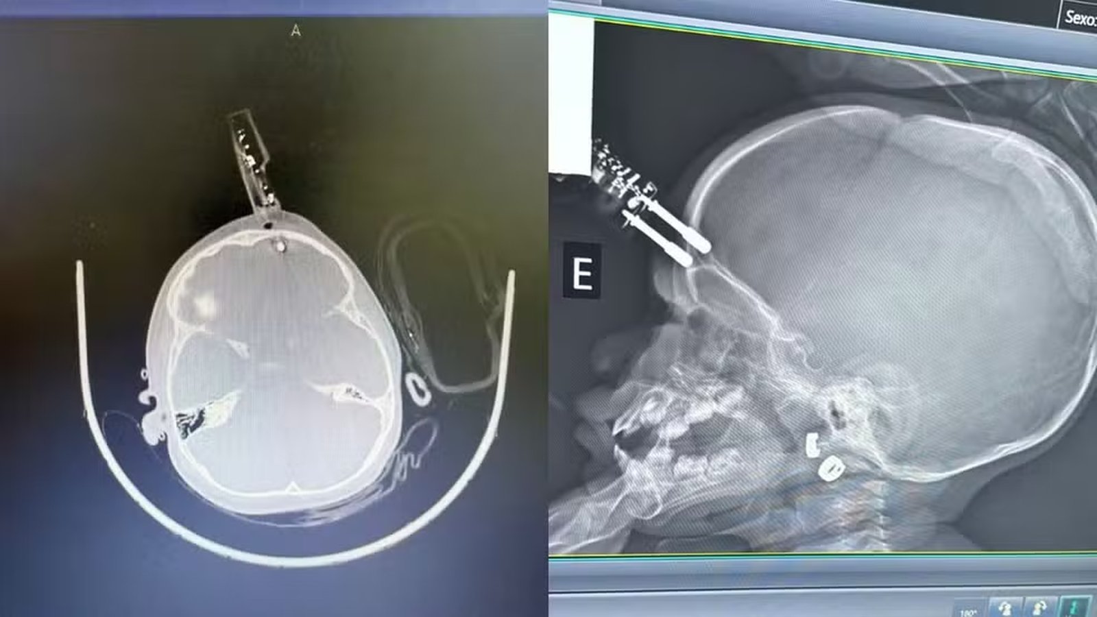 Criança fica com carregador cravado na testa após cair de cama
